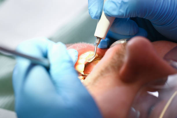 Best Emergency Tooth Extraction in Garner, NC